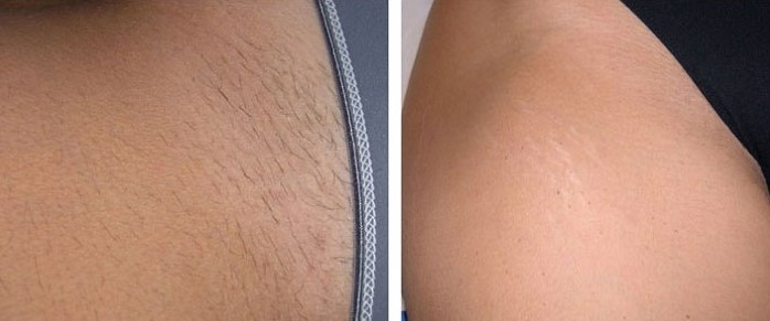 Intimzone vor und nach der dauerhaften Haarentfernung mit dem Diodenlaser