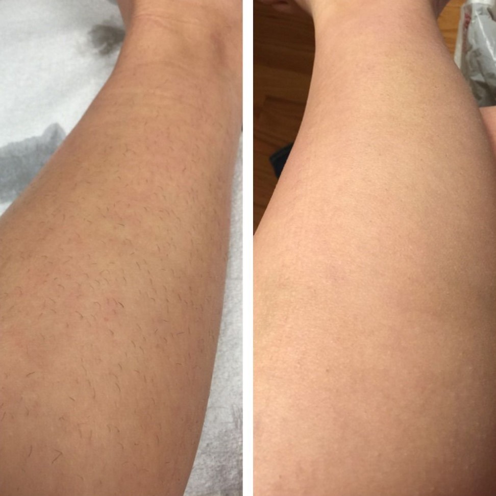 Beine vor und nach der dauerhaften Haarentfernung mit dem Diodenlaser