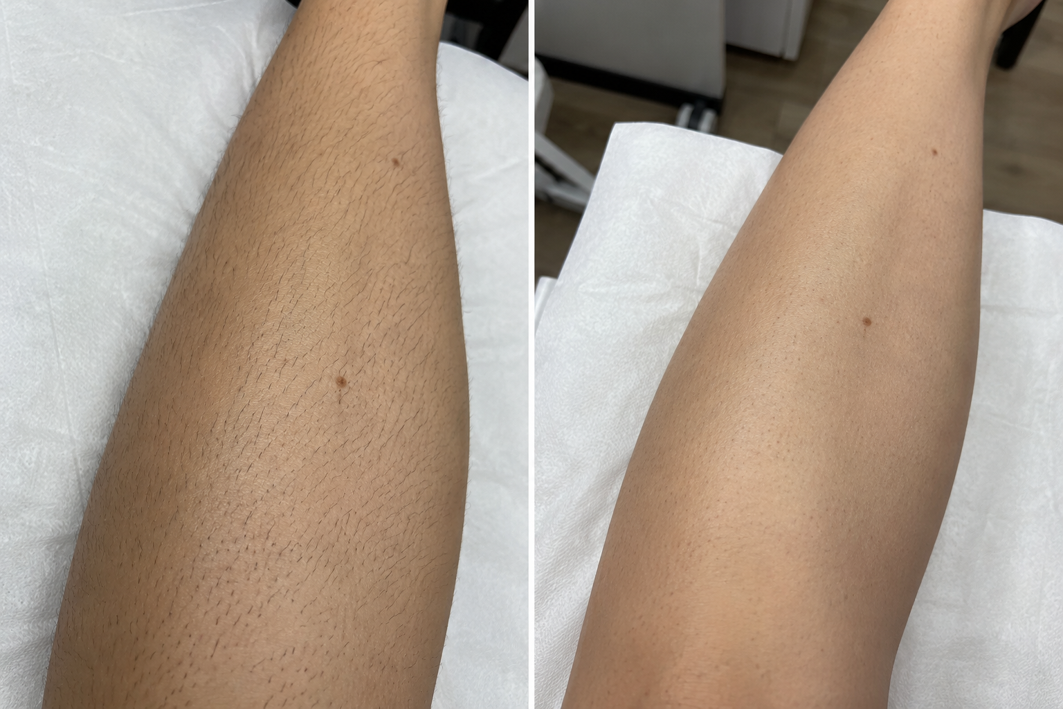 Unterschenkel vor und nach mehreren Behandlungen mit dem Diodenlaser